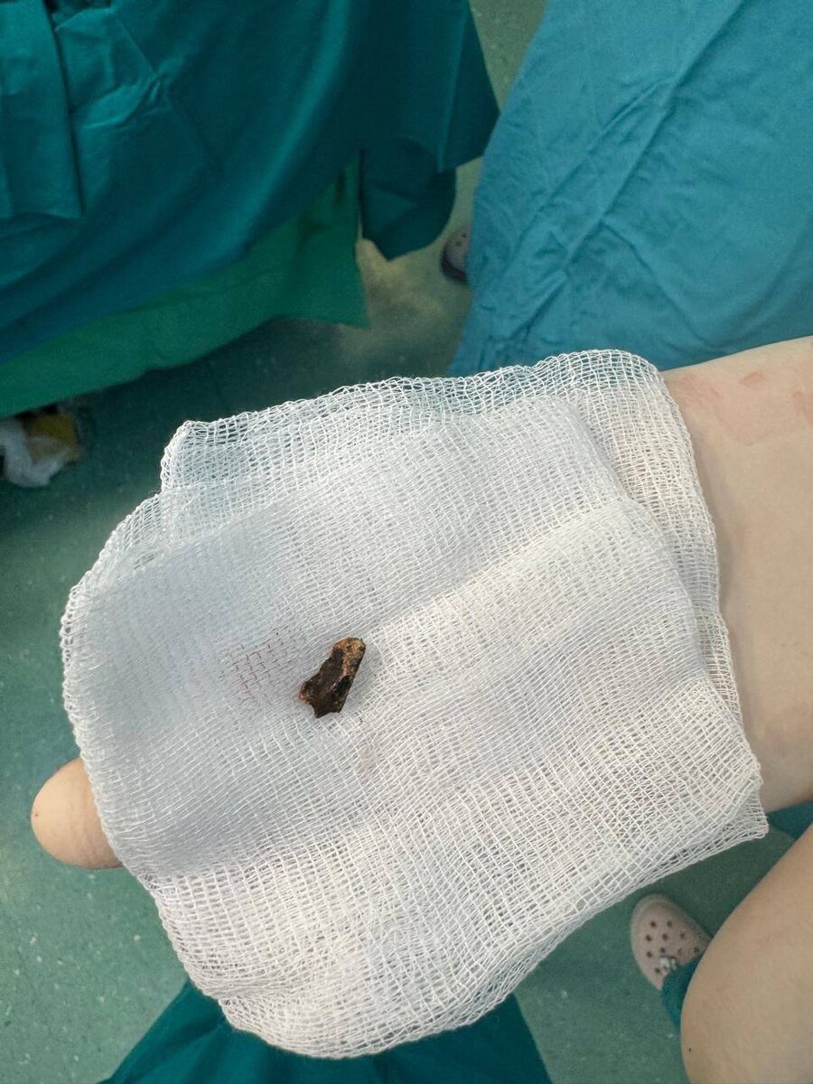    Врачи в Татарстане удалили осколок у бойца СВО