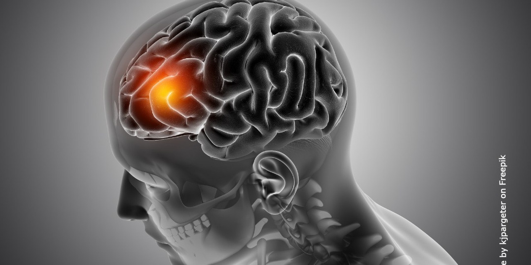 🏥 Как предотвратить повторный инсульт
