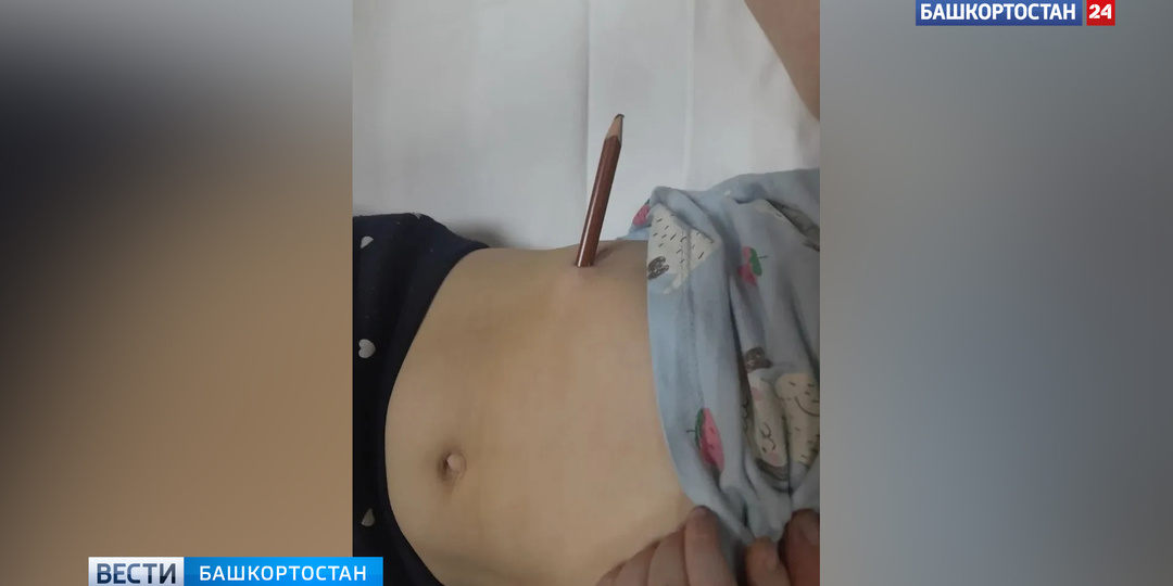 В Башкортостане ребенок во время игры упал на пенал с карандашами и проткнул живот