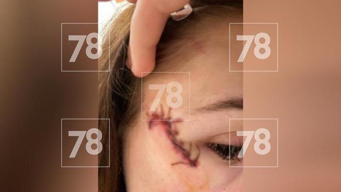 Травма девушки. Фото © Telegram / 78 | НОВОСТИ