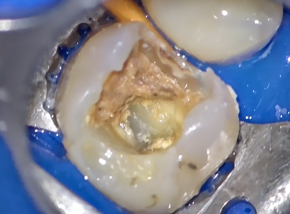 Удалена временная пломба