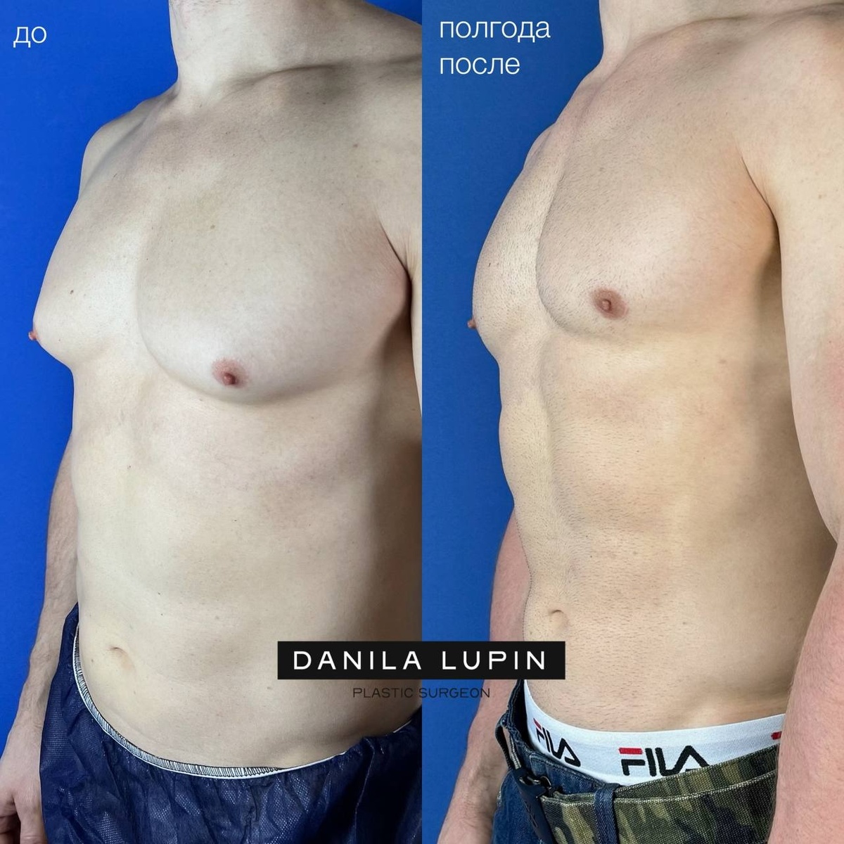 Мой пациент. Выполнили удаление гинекомастии.