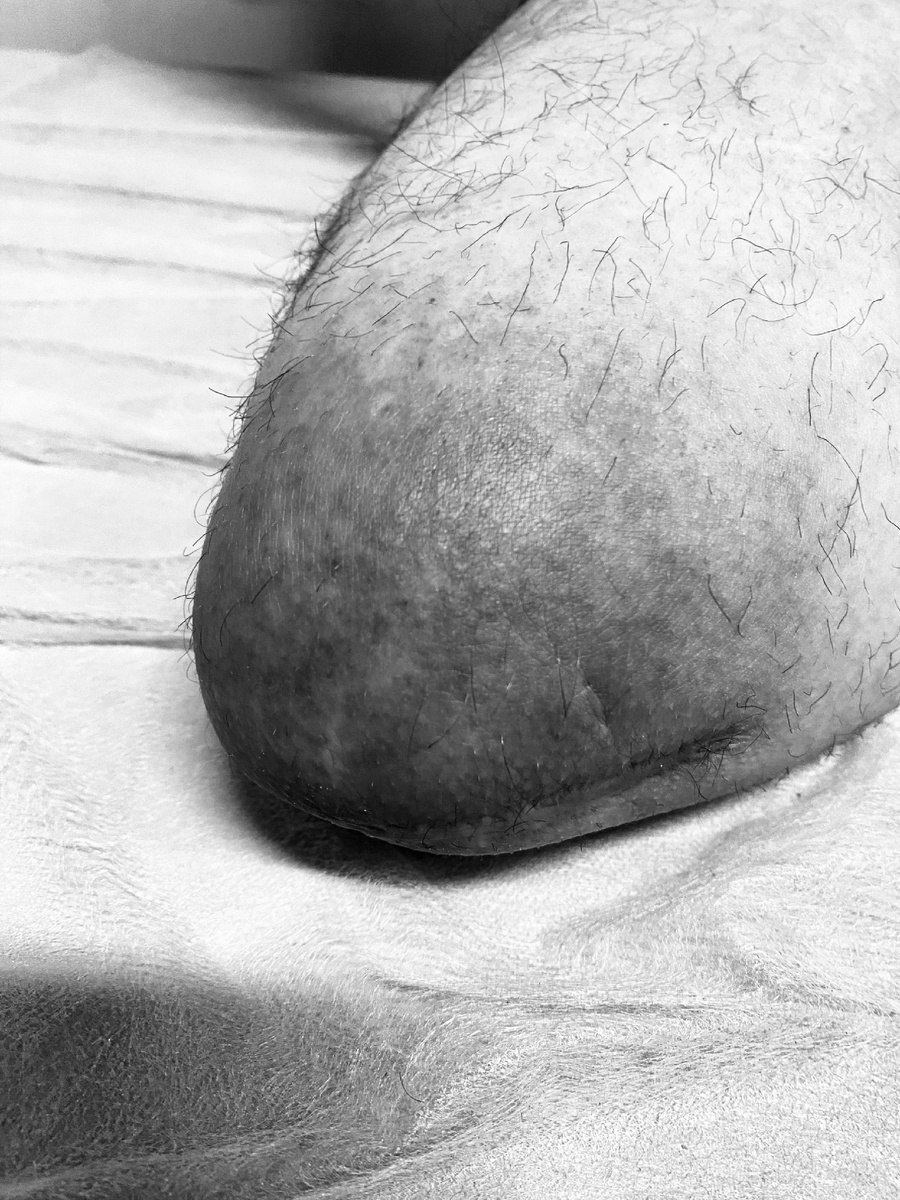 Пример  потертости , мозоли 