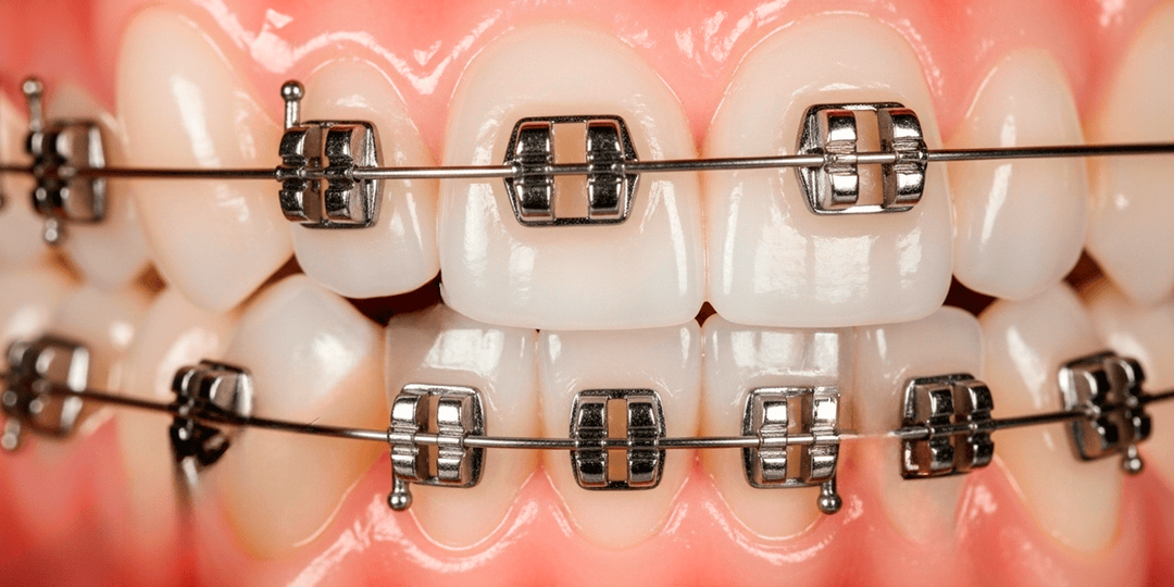 Боль после замены дуги на брекетах: сколько дней длится и как облегчить