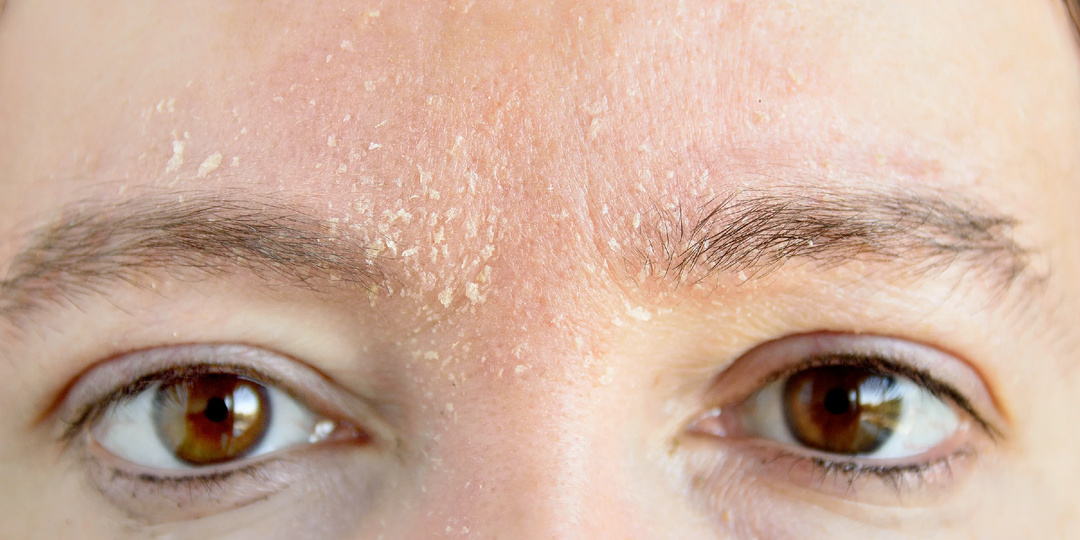 7 внешних сигналов холестерина, которые нельзя игнорировать