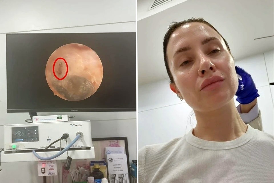    Врачи благополучно вытащили муравья из уха. Фото: Предоставлено Еленой Мещеряковой
