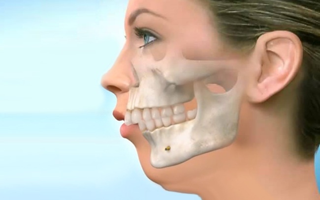 Нижняя челюсть (зубной ряд) смещена назад относительно верхней. (Дистальный прикус)