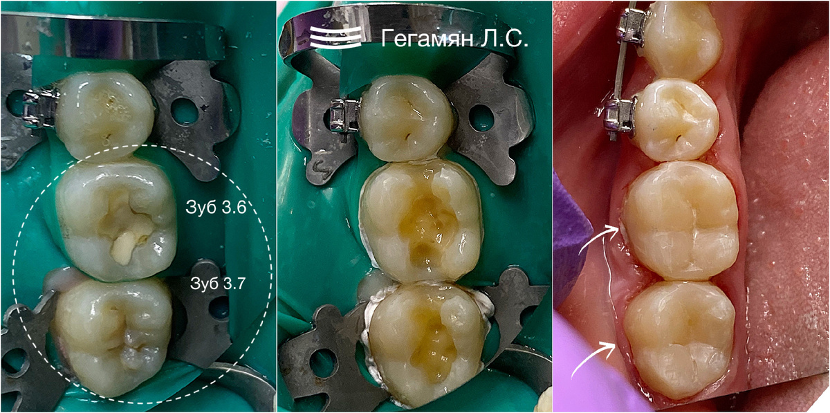 Лечение кариеса дентина зубов 3.6 и 3.7