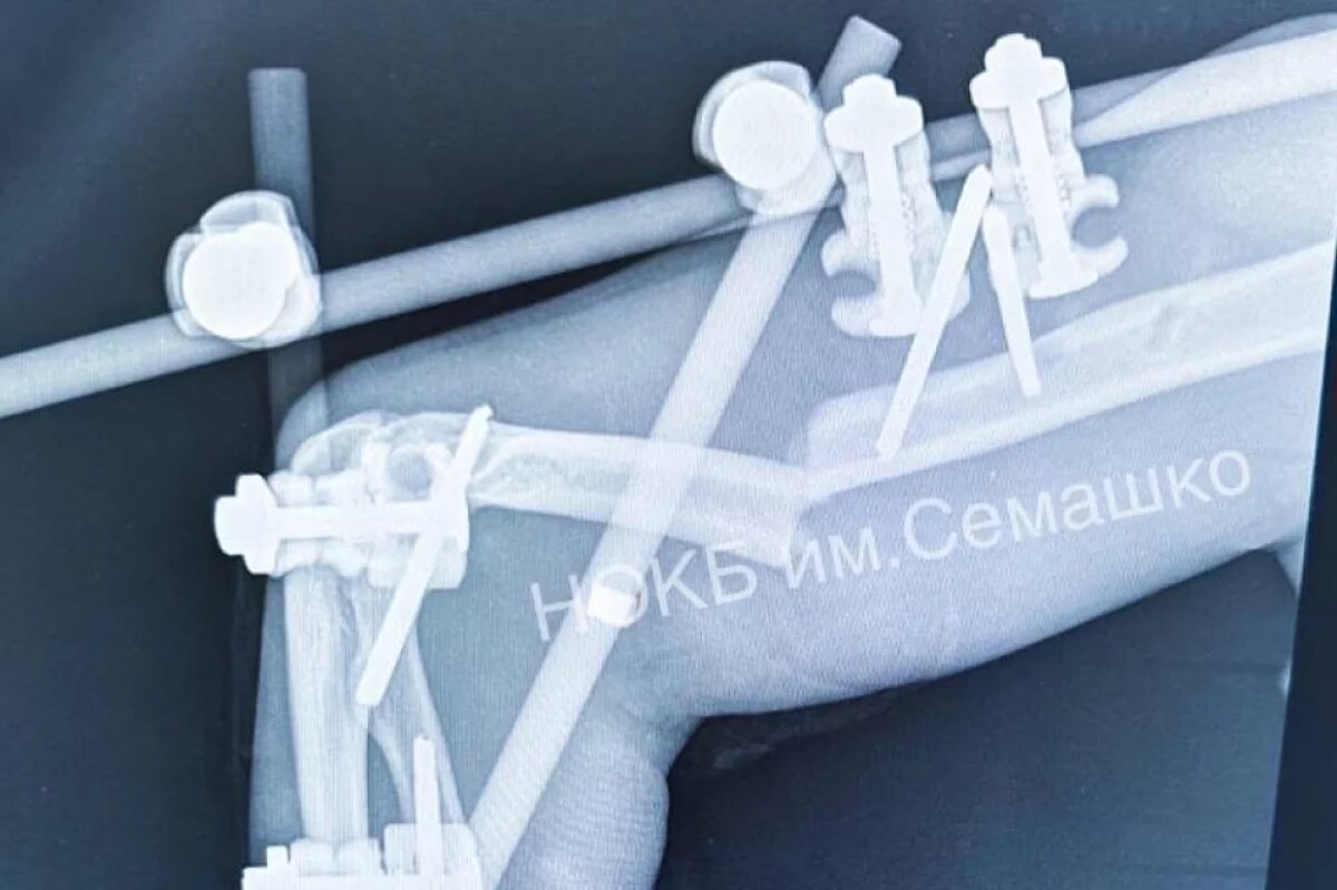    Переломы от носа до пяток.