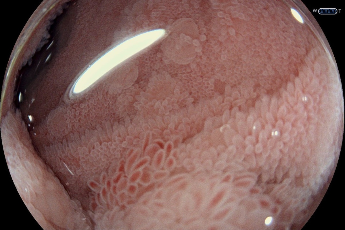 Рис. 1-2. Эндофото слизистой