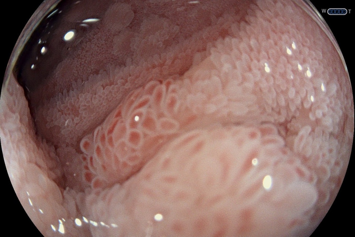 Рис. 1-2. Участки измененной слизистой