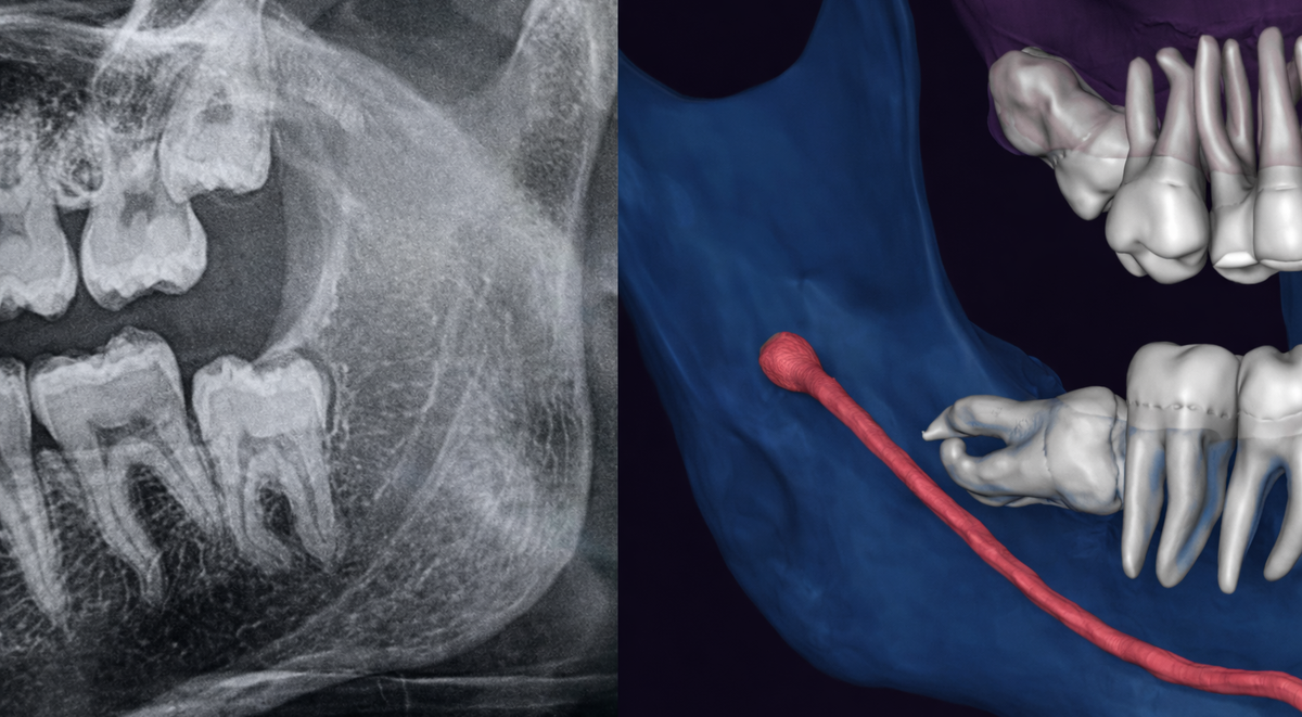 Восьмерки близко к нерву нижней челюсти