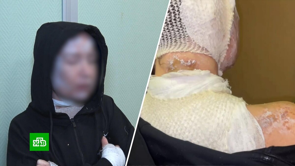    Облитая кислотой екатеринбурженка просит защитить ее от бывшего мужа