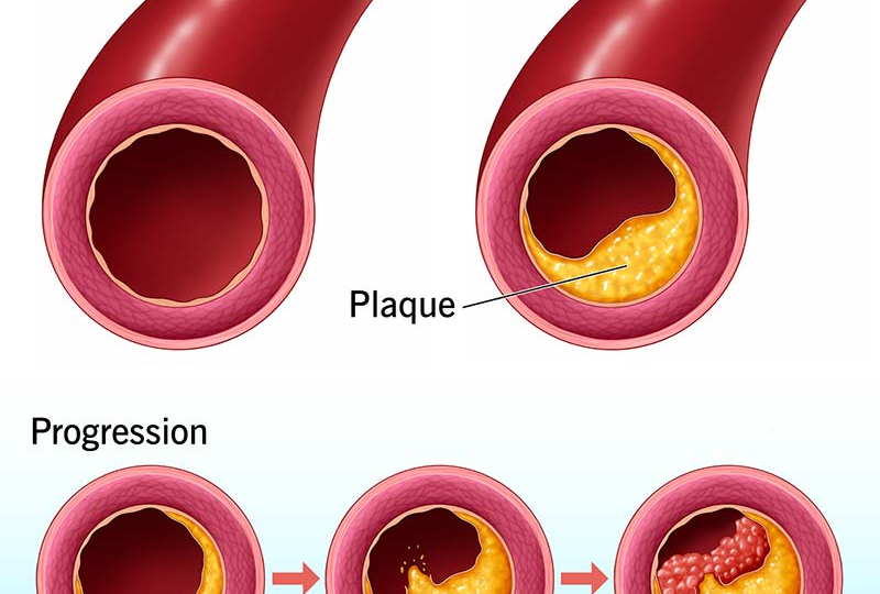 Агрессивное течение атеросклероза: кому грозит?