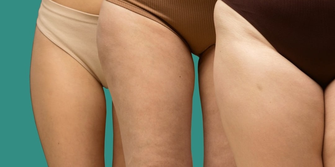 Инструкция от целлюлита | Разбираемся, откуда берется «апельсиновая корка» и что с ней делать