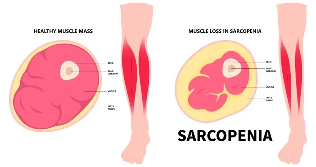 Остеопороз и саркопения: как не дать возрасту украсть вашу силу и опору