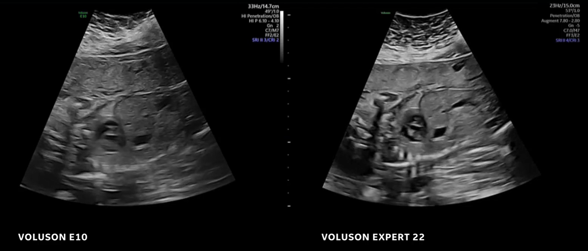 Благодаря новым технологиям изображение в B-режиме стало гораздо более чётким и контрастным