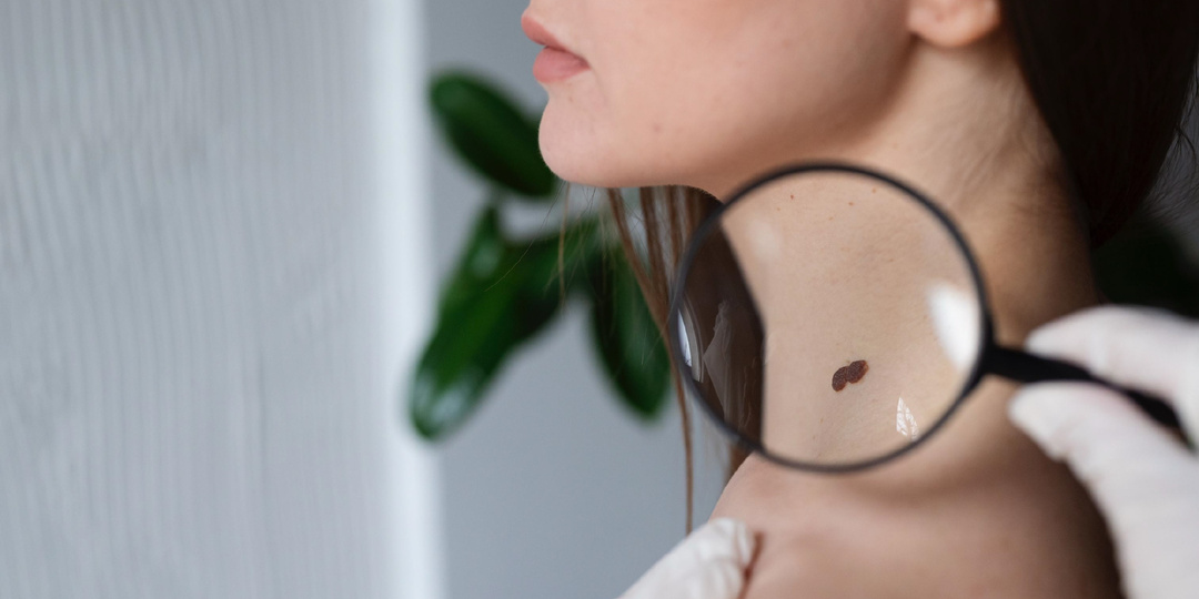 Родинки: Зачем их удалять? И когда это необходимо?