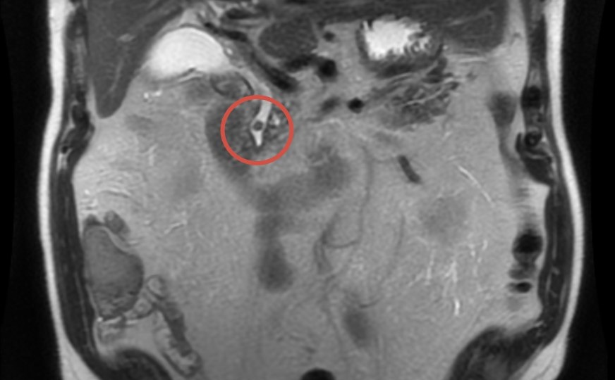 «Невидимый» камень: от боли в эпигастрии до билиарного сепсиса