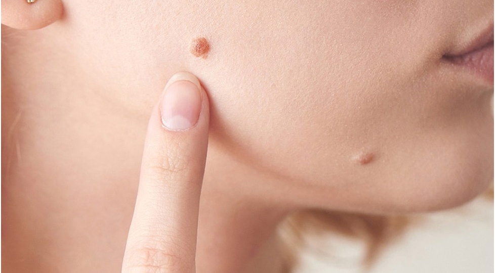 Папилломы: что на самом деле скрывается под этими наростами и как с ними жить