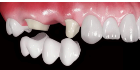 В среднем мост служит 7-10 лет, после чего вопрос восстановления снова встает на повестке дня.