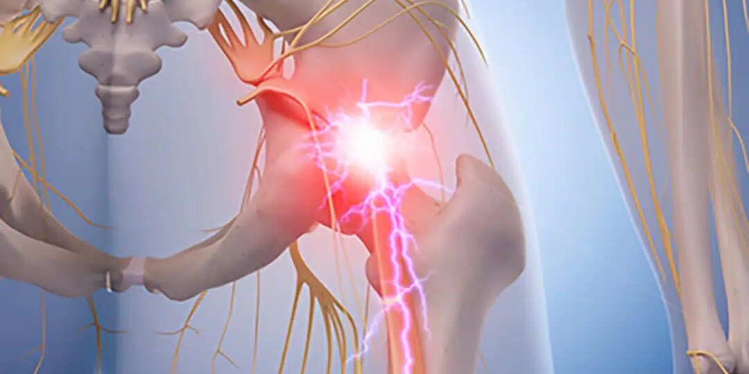 Стреляет в ногу, не даёт ходить: защемление седалищного нерва — как распознать, что делать и как вернуть подвижность без операции