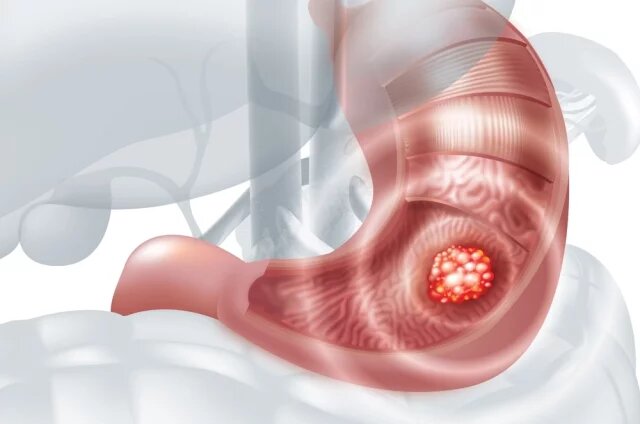    Каковы ранние симптомы рака желудка?