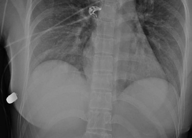 Рентген ранения 