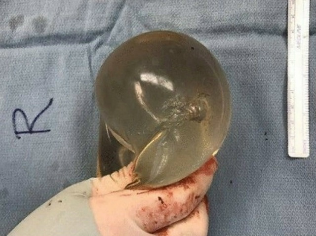 Фото импланта