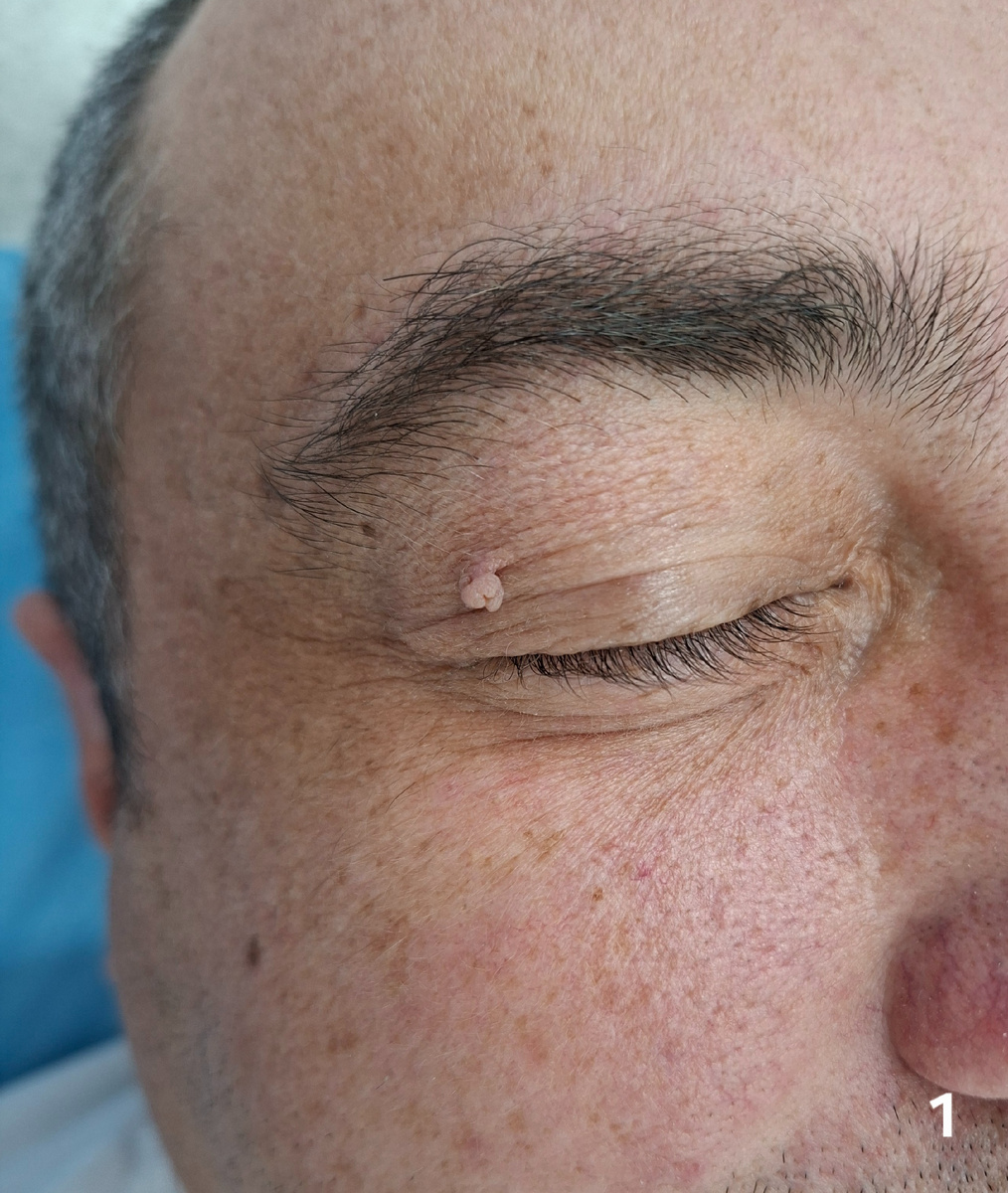 Перед операцией. Свисающая ппиллома хорошо видна на коже.