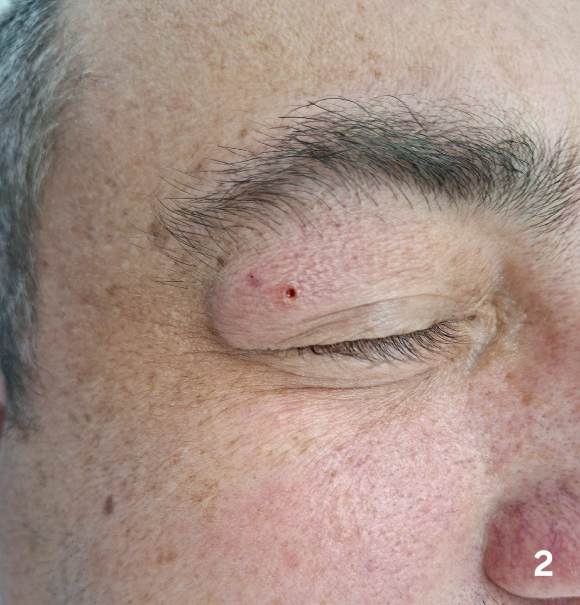 Состояние сразу после удаления. Область воздействия высокочастотной энергии представляет собой небольшое кратерообразное (мельче 1 миллиметра) углубление. Небольшой отек века.