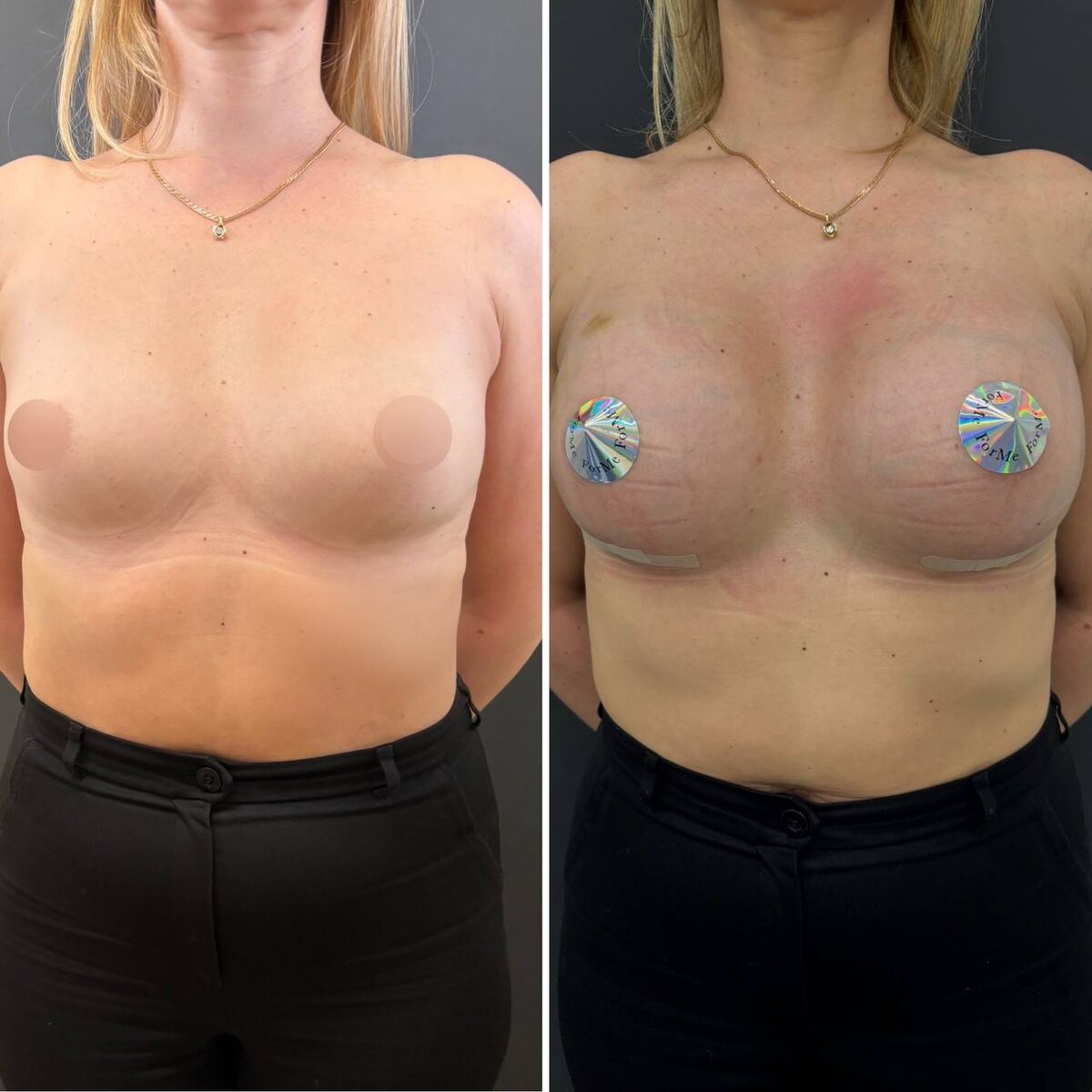 Увеличение молочных желез круглыми имплантами: результат на сроке 3 недели после операции. Хирург Остринская Т.В.