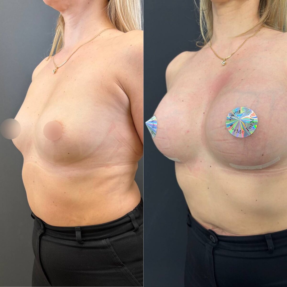 Увеличение молочных желез круглыми имплантами: результат на сроке 3 недели после операции. Хирург Остринская Т.В.