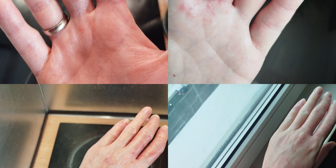 Экзема кистей: клинический случай  (история одной пациентки и путь к улучшению)