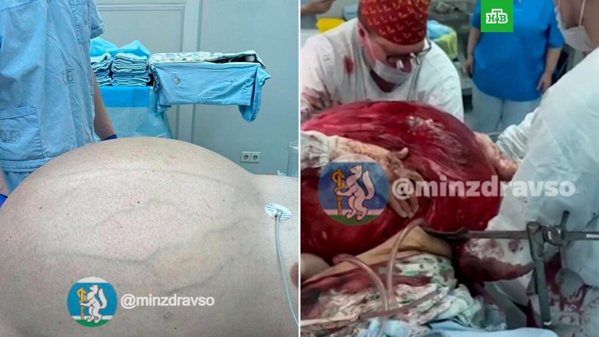    Жителю Урала удалили 60-килограммовую опухоль