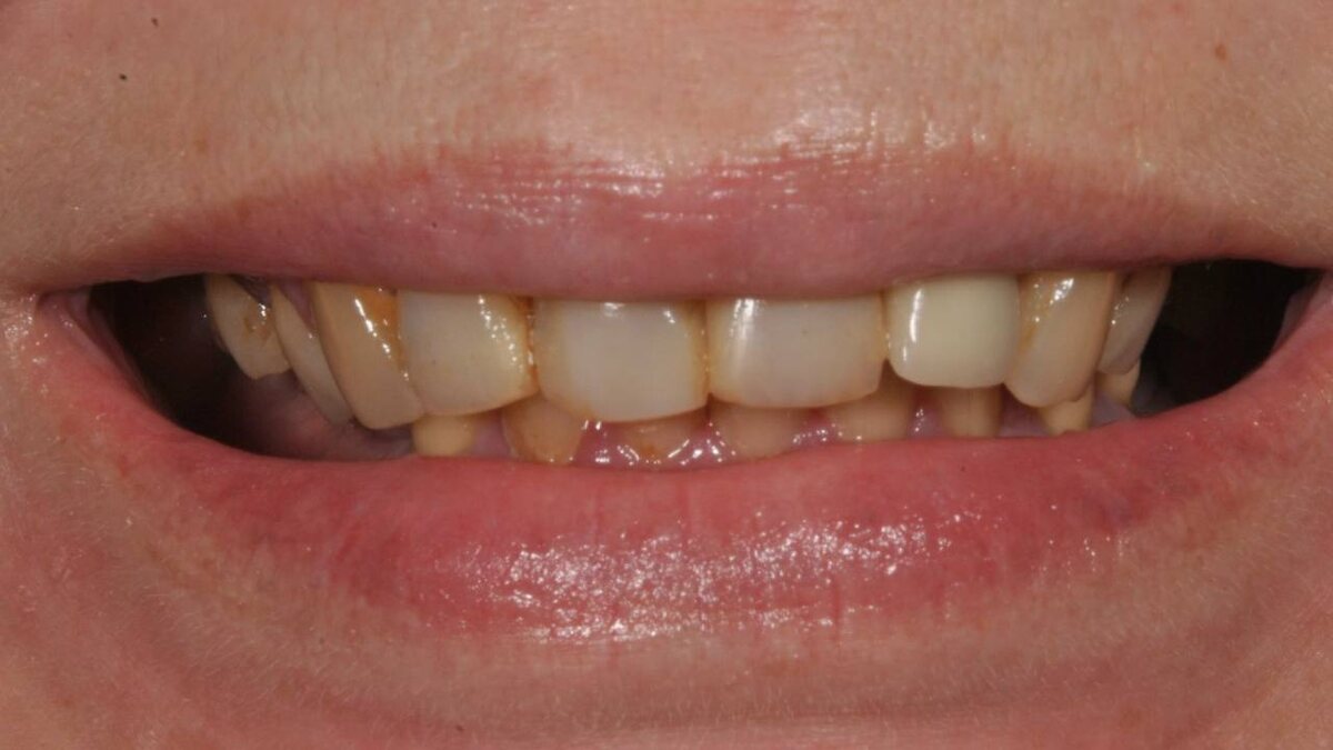 Так выглядела улыбка пациентки до лечения