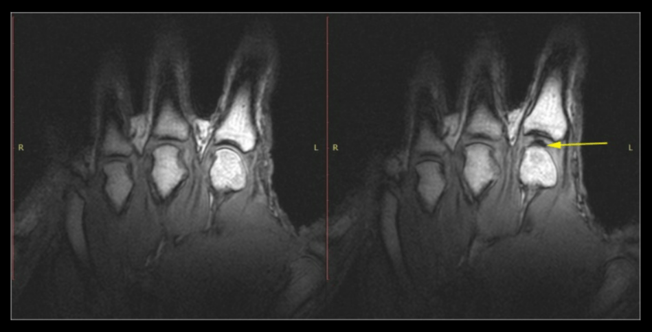    Слева: рука в покое перед растрескиванием. Справа: та же рука после хруста от растяжения. Обратите внимание на тёмную межсуставную полость (жёлтая стрелка). Источник изображения: pubmed.ncbi.nlm.nih.gov
