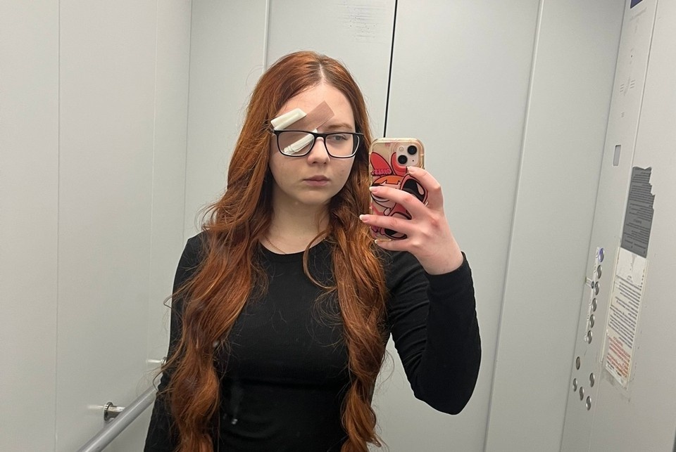    Левый глаз пришлось удалить. Фото: Предоставлено Аленой