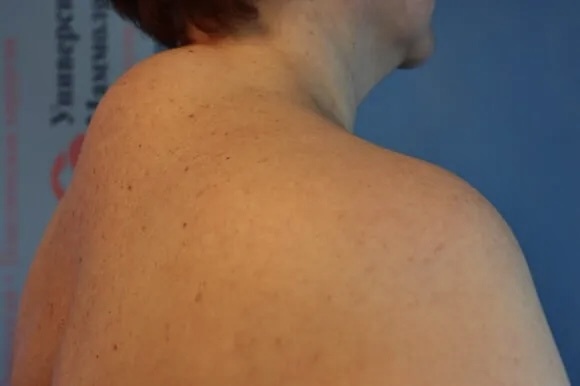 Холка на шее. Причины появления. Способы борьбы.