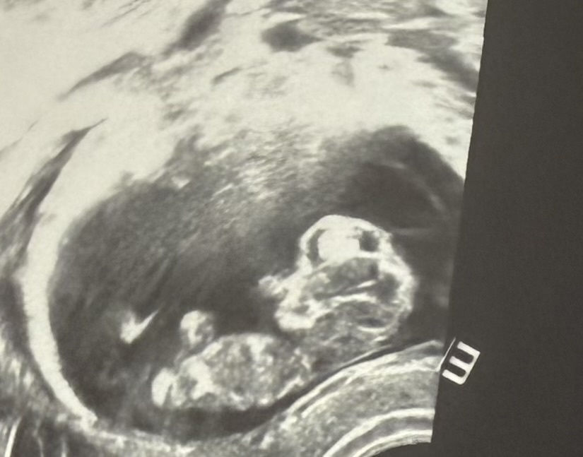 Маточная беременность 11 недель. Фото  автора.