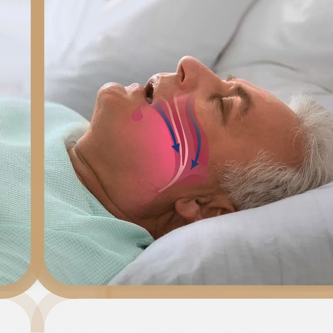 Сдавливание дыхательных путей при храпе затрудняет проход воздуха