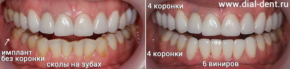 до и после протезирования зубов