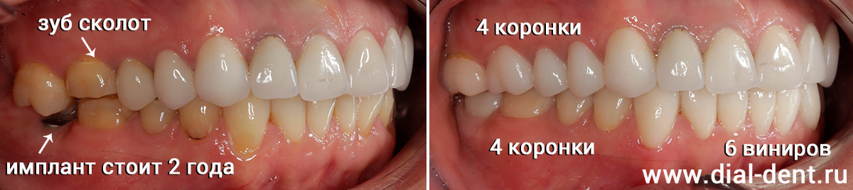 до и после протезирования зубов