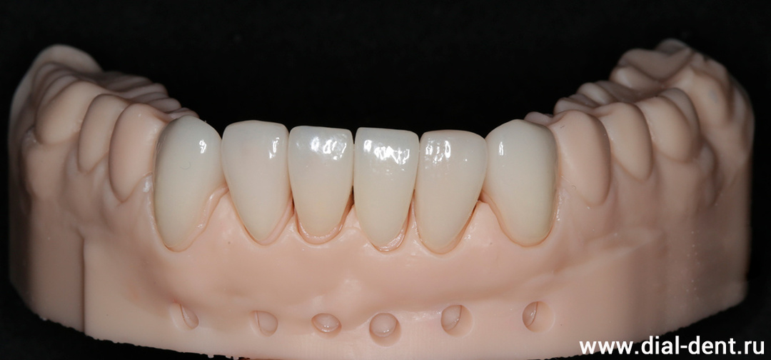 Керамические виниры для нижних зубов и протезирование правой стороны керамическими коронками