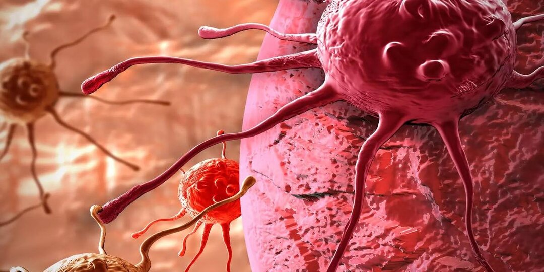 Как остановить и уничтожить метастазы при раке