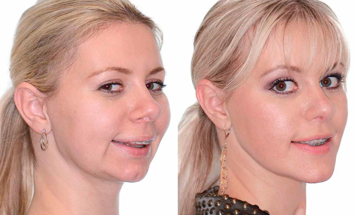 Коррекция глубокого прикуса.