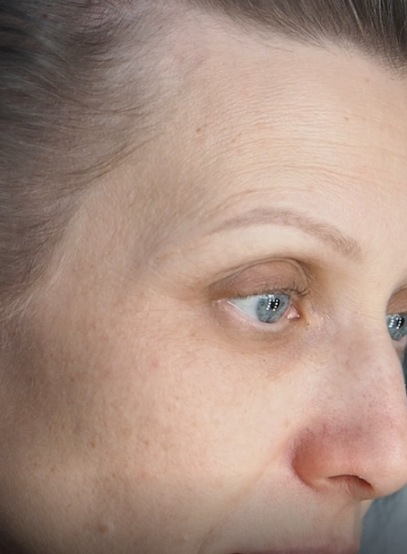 Фото 1. Кожа светлая, проступают розовые сосуды, пигментация