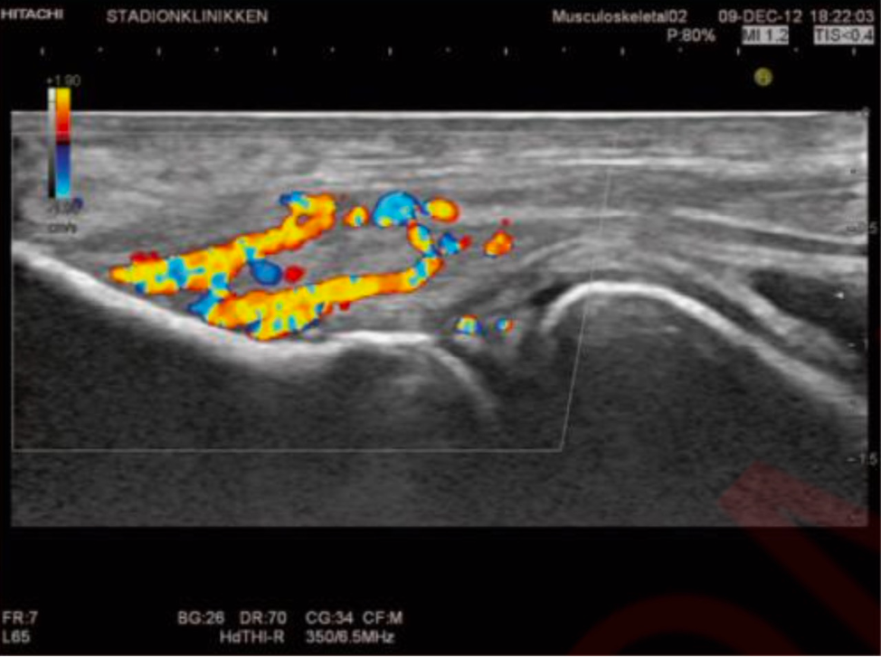 Пример воспаления сухожилий-разгибателей на УЗИ  