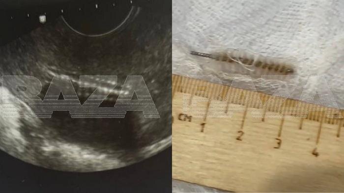 Гинеколог промолчала об отломившемся ёршике от щётки внутри пациентки. Фото © Telegram / Baza