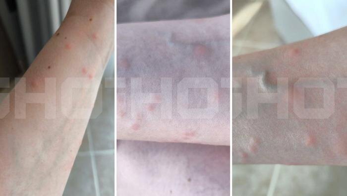 В пятизвёздочных отелях ОАЭ клопы атаковали российских туристов. Фото © Telegram / SHOT